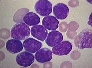 Imagem da notícia - Como identificar leucemias agudas