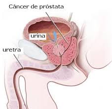 Imagem da notícia - Histórico de câncer de próstata na família pode aumentar em cinco vezes as chances de contrair a doença